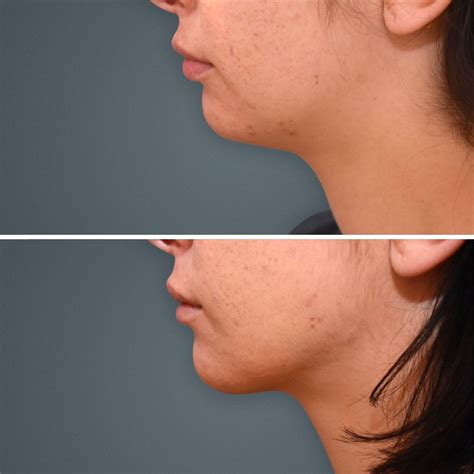 coolsculpting gold coast|Cosmos Aesthetics Gold Coast .